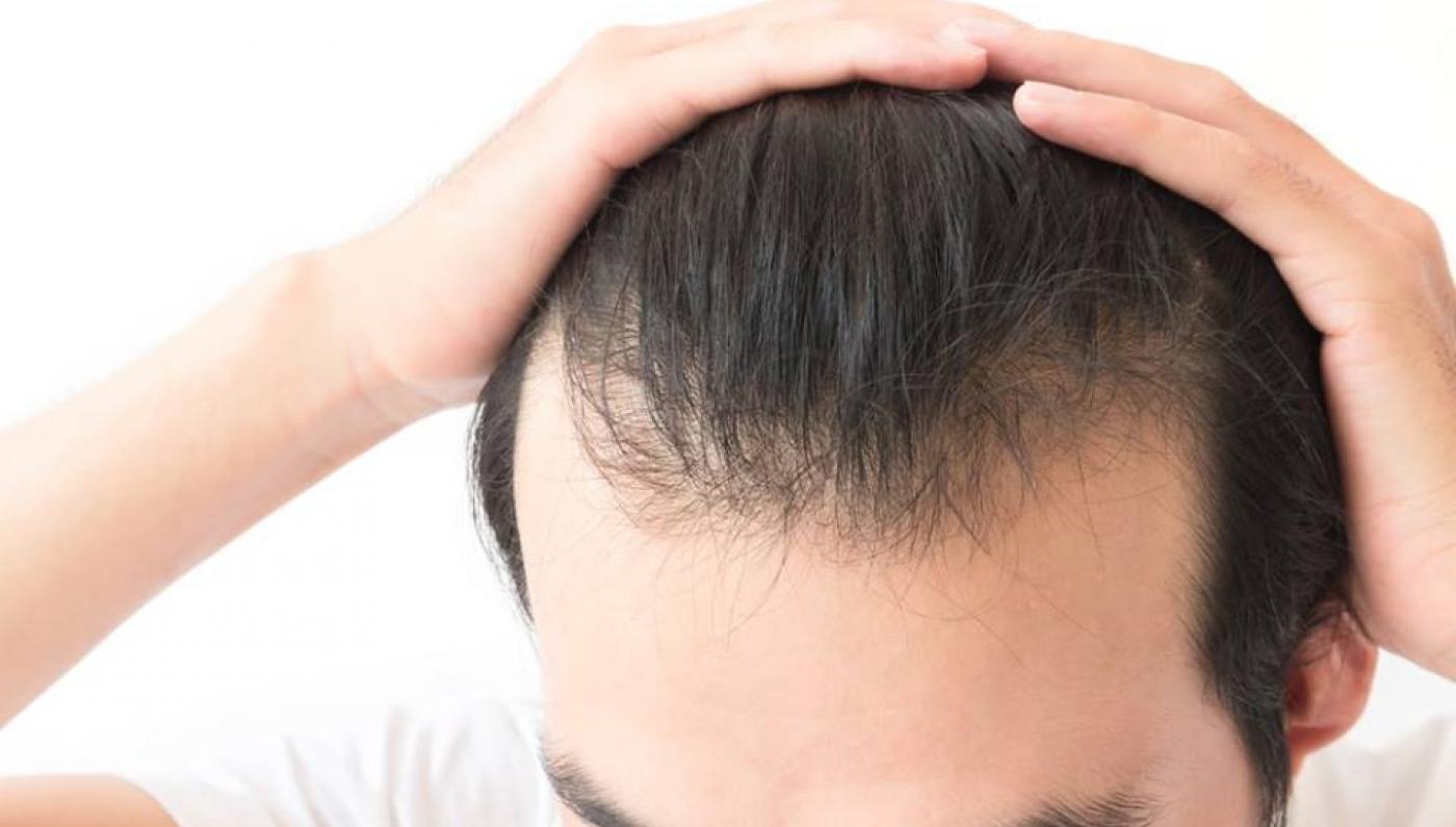 معلومات خاصة بزراعة الشعر والتعامل معها بطريقة صحيحة - فيديو